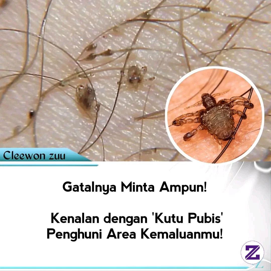 Gambar Kenapa Kutu Kemaluan Beda Banget Sama Kutu Rambut? kategori Berita dipublikasikan oleh Linux Satu di Zoyalink